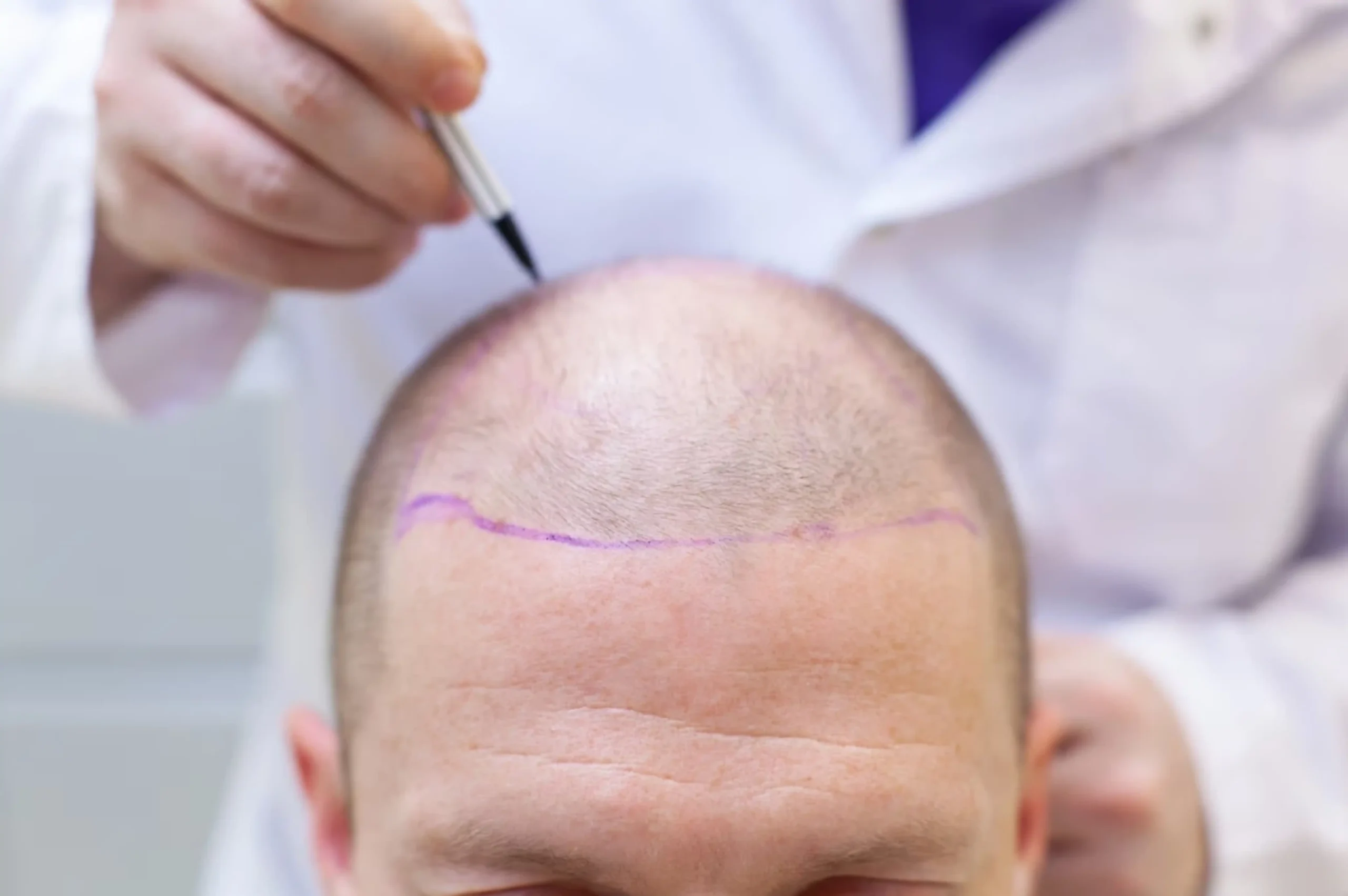 Tricopigmentation